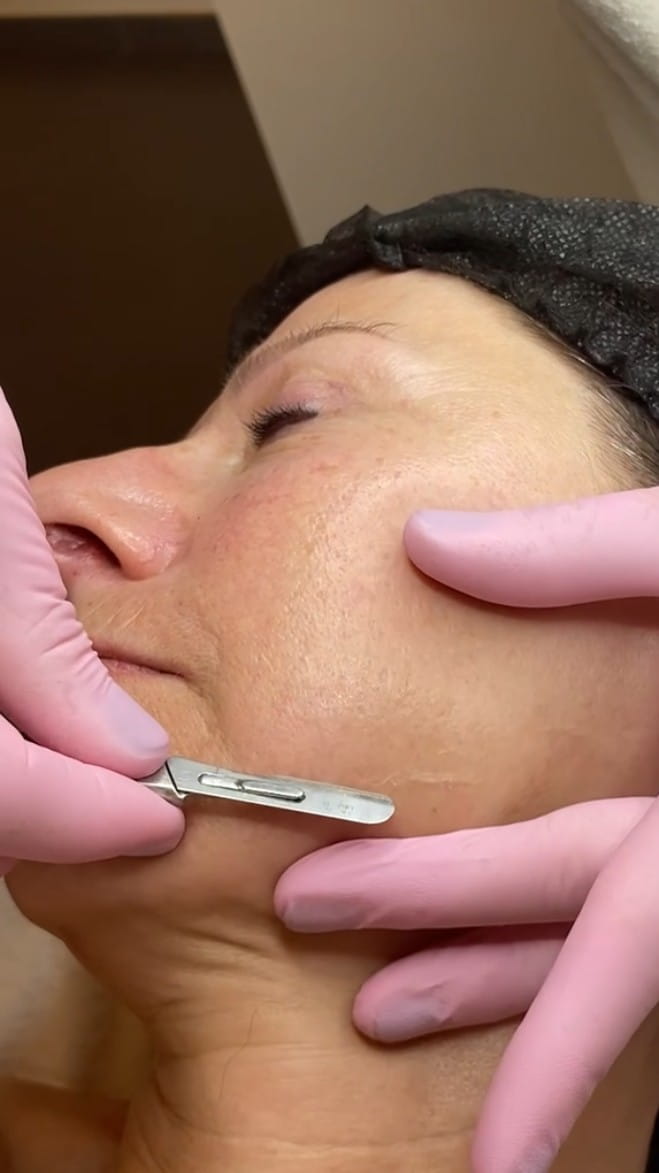 Dermaplaning